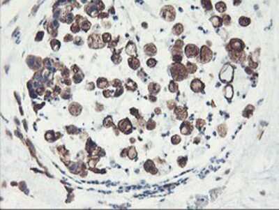 Immunohistochemistry-Paraffin: PFKP Antibody (1D6) [NBP2-01539] - Staining of paraffin-embedded Adenocarcinoma of Human colon tissue using anti-PFKP mouse monoclonal antibody.