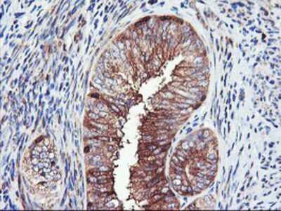 Immunohistochemistry-Paraffin: PFKP Antibody (1D6) [NBP2-01539] - Staining of paraffin-embedded Adenocarcinoma of Human endometrium tissue using anti-PFKP mouse monoclonal antibody.