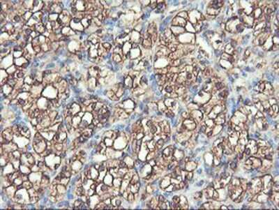 Immunohistochemistry-Paraffin: PFKP Antibody (1D6) [NBP2-01539] - Staining of paraffin-embedded Carcinoma of Human kidney tissue using anti-PFKP mouse monoclonal antibody.