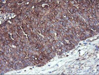 Immunohistochemistry: PFKP Antibody (OTI1D6) - Azide and BSA Free [NBP2-73344] - Staining of paraffin-embedded Adenocarcinoma of Human ovary tissue using anti-PFKP mouse monoclonal antibody.