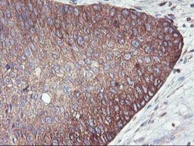 Immunohistochemistry: PFKP Antibody (OTI1D6) - Azide and BSA Free [NBP2-73344] - Staining of paraffin-embedded Carcinoma of Human bladder tissue using anti-PFKP mouse monoclonal antibody.