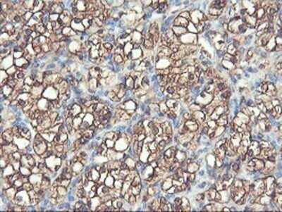 Immunohistochemistry: PFKP Antibody (OTI1D6) - Azide and BSA Free [NBP2-73344] - Staining of paraffin-embedded Carcinoma of Human kidney tissue using anti-PFKP mouse monoclonal antibody.
