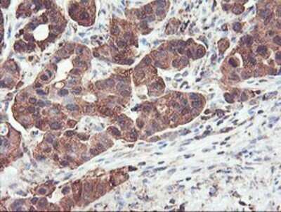 Immunohistochemistry: PFKP Antibody (OTI1D6) - Azide and BSA Free [NBP2-73344] - Staining of paraffin-embedded Carcinoma of Human lung tissue using anti-PFKP mouse monoclonal antibody.
