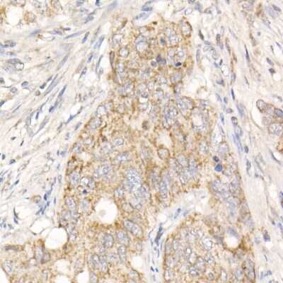 Immunohistochemistry-Paraffin: PGAM5 Antibody [NBP2-93600] - Human colon carcinoma using PGAM5 Rabbit pAb (NBP2-93600) at dilution of 1:25 (40x lens). Perform high pressure antigen retrieval with 10 mM citrate buffer pH 6.0 before commencing with IHC staining protocol.