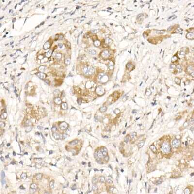 Immunohistochemistry-Paraffin: PGAM5 Antibody [NBP2-93600] - Human liver cancer using PGAM5 Rabbit pAb (NBP2-93600) at dilution of 1:25 (40x lens). Perform high pressure antigen retrieval with 10 mM citrate buffer pH 6.0 before commencing with IHC staining protocol.