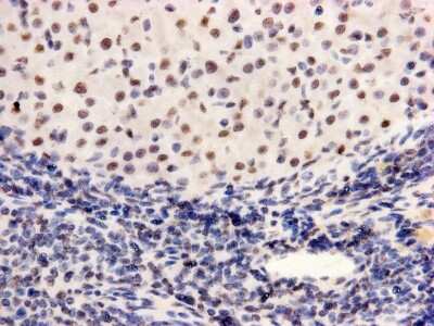 Immunohistochemistry-Paraffin: PGBD5 Antibody (7-F8-5) [NBP2-67048] - Analysis of paraffin- embedded human lung cancer tissue using anti-PGBD5 Mouse mAb.