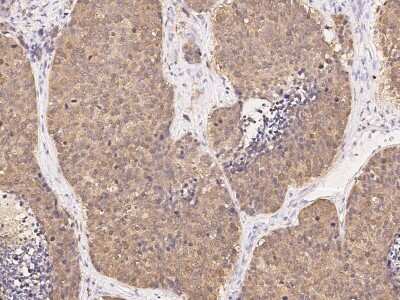 Immunohistochemistry-Paraffin: PGD Antibody [NBP2-99282] - Immunochemical staining of human PGD in human lung cancer with rabbit polyclonal antibody (1:5000, formalin-fixed paraffin embedded sections).