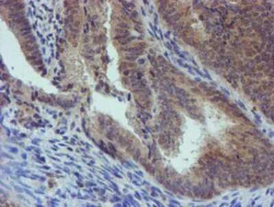 Immunohistochemistry: PGM3 Antibody (OTI1A11) - Azide and BSA Free [NBP2-73362] - Staining of paraffin-embedded Adenocarcinoma of Human endometrium tissue using anti-PGM3 mouse monoclonal antibody.