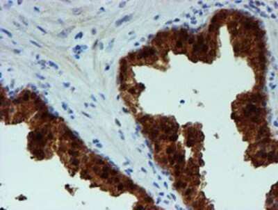 Immunohistochemistry: PGM3 Antibody (OTI1A11) - Azide and BSA Free [NBP2-73362] - Staining of paraffin-embedded Carcinoma of Human prostate tissue using anti-PGM3 mouse monoclonal antibody.