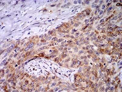Immunohistochemistry: PGRMC1 Antibody (7G11G8) [NBP2-61779] - Analysis of paraffin-embedded cervical cancer tissues using PGRMC1 mouse mAb with DAB staining.