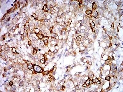 Immunohistochemistry: PGRMC1 Antibody (7G11G8) [NBP2-61779] - Analysis of paraffin-embedded breast cancer tissues using PGRMC1 mouse mAb with DAB staining.
