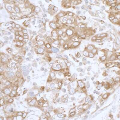 <b>Biological Strategies Validation. </b>Immunohistochemistry: PGRMC1 Antibody [NBP2-36525] - Sample: FFPE section of human breast carcinoma. Antibody: Affinity purified rabbit anti- PGRMC1 used at a dilution of 1:5,000 (0.2ug/ml). Detection: DAB. Counterstain: IHC Hematoxylin (blue).