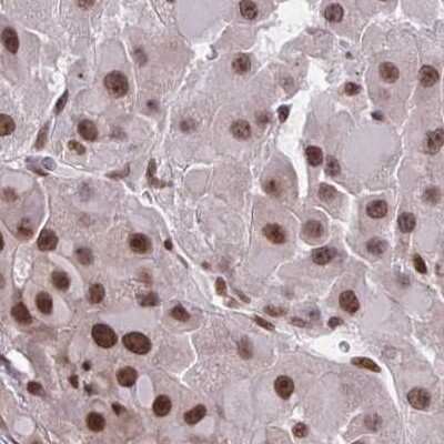 Immunohistochemistry-Paraffin: PHF10 Antibody [NBP2-33759] - Staining of liver cancer.