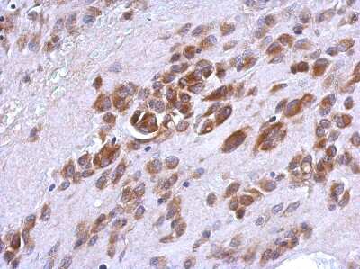 Immunohistochemistry-Paraffin: Jade-1/PHF17 Antibody [NBP2-19797] - Human hepatoma, using PHF17 antibody at 1:500 dilution. Antigen Retrieval: Trilogy™ (EDTA based, pH 8.0) buffer, 15min. 