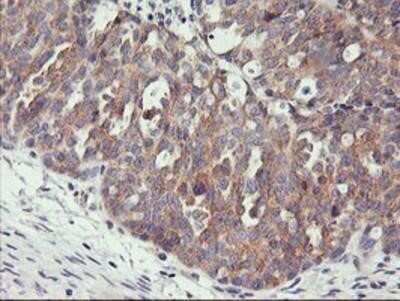 Immunohistochemistry: PHF21B Antibody (OTI3D1) - Azide and BSA Free [NBP2-73367] - Staining of paraffin-embedded Adenocarcinoma of Human ovary tissue using anti-PHF21B mouse monoclonal antibody.