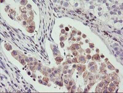Immunohistochemistry: PHF21B Antibody (OTI3D1) - Azide and BSA Free [NBP2-73367] - Staining of paraffin-embedded Carcinoma of Human lung tissue using anti-PHF21B mouse monoclonal antibody.