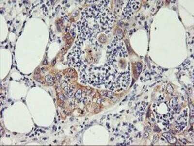 Immunohistochemistry: PHF21B Antibody (OTI3D1) - Azide and BSA Free [NBP2-73367] - Staining of paraffin-embedded Carcinoma of Human pancreas tissue using anti-PHF21B mouse monoclonal antibody.
