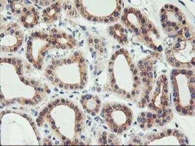 Immunohistochemistry: PHF21B Antibody (OTI3D1) - Azide and BSA Free [NBP2-73367] - Staining of paraffin-embedded Carcinoma of Human thyroid tissue using anti-PHF21B mouse monoclonal antibody.