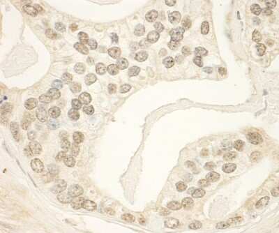 <b>Independent Antibodies Validation. </b>Immunohistochemistry: PHF23 Antibody [NBP1-28747] - Sample: FFPE section of human prostate carcinoma. Antibody: Affinity purified rabbit anti- PHF23 used at a dilution of 1:1,000 (1ug/ml). Detection: DAB.