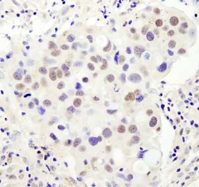 <b>Independent Antibodies Validation and Biological Strategies Validation.</b>Immunohistochemistry-Paraffin: PHF6 Antibody [NB100-68261] - Section of human breast carcinoma. Affinity purified rabbit anti- PHF6 used at 1:200 (1 ug/mL). Detection by DAB.