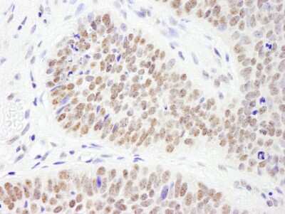 <b>Independent Antibodies Validation and Biological Strategies Validation.</b>Immunohistochemistry-Paraffin: PHF6 Antibody [NB100-68262] - Sample: FFPE section of human skin carcinoma. Antibody: Affinity purified rabbit anti- PHF6 used at a dilution of 1:200 (1ug/ml). Detection: DAB