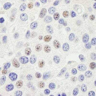 <b>Independent Antibodies Validation and Biological Strategies Validation.</b>Immunohistochemistry-Paraffin: PHF6 Antibody [NB100-68260] - Sample: FFPE section of human breast carcinoma.  Antibody: Affinity purified rabbit anti-PHF6  used at a dilution of 1:200 (1ug/ml). Detection: DAB