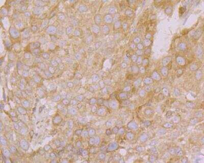 Immunohistochemistry: PHF8 Antibody [NBP2-76957] - Immunohistochemical analysis of paraffin-embedded human lung cancer tissue using anti-PHF8 antibody. Counter stained with hematoxylin.