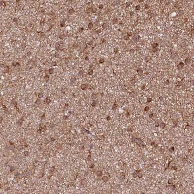 Immunohistochemistry-Paraffin: PHLDB1 Antibody [NBP1-90450] - Staining of human glioma shows moderate to strong cytoplasmic positivity in tumor cells.