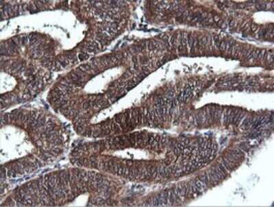 Immunohistochemistry: PI 3-Kinase C2 beta Antibody (3B1) [NBP2-46402] - Analysis of Adenocarcinoma of Human endometrium tissue. (Heat-induced epitope retrieval by 10mM citric buffer, pH6.0, 120C for 3min)