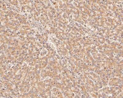 Immunohistochemistry-Paraffin: PI 3-Kinase p110 beta/PIK3CB Antibody (SC0580) [NBP2-67579] - Immunohistochemical analysis of paraffin-embedded human liver carcinoma tissue using anti-PI 3-Kinase p110 beta/PIK3CB antibody. The section was pre-treated using heat mediated antigen retrieval with Tris-EDTA buffer (pH 8.0-8.4) for 20 minutes. The tissues were blocked in 5% BSA for 30 minutes at room temperature, washed with ddH2O and PBS, and then probed with the primary antibody (ET1610-36, 1/50) for 30 minutes at room temperature. The detection was performed using an HRP conjugated compact polymer system. DAB was used as the chromogen. Tissues were counterstained with hematoxylin and mounted with DPX.