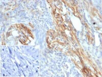 Immunohistochemistry-Paraffin: PI 3-Kinase p85 beta Antibody (PIK3R2/292) [NBP3-13735] - Formalin-fixed, paraffin-embedded human bladder carcinoma stained with PI 3-Kinase p85 beta antibody (PIK3R2/292). Inset: PBS instead of primary antibody; secondary only negative control.