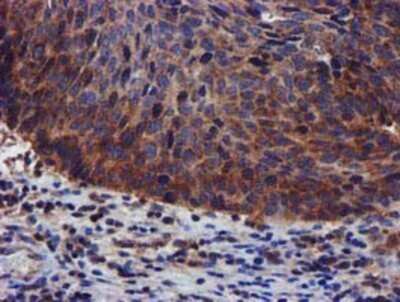 Immunohistochemistry: PIH1D2 Antibody (OTI4A10) - Azide and BSA Free [NBP2-73403] - Staining of paraffin-embedded Carcinoma of Human bladder tissue using anti-PIH1D2 mouse monoclonal antibody.