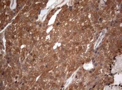 Immunohistochemistry: PIK3CA Antibody (6D9) [NBP2-46403] - Analysis of Adenocarcinoma of Human breast tissue. (Heat-induced epitope retrieval by 1 mM EDTA in 10mM Tris, pH8.5, 120C for 3min)