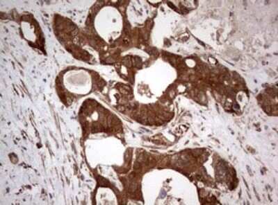 Immunohistochemistry: PIK3CA Antibody (6D9) [NBP2-46403] - Analysis of Adenocarcinoma of Human colon tissue. (Heat-induced epitope retrieval by 1 mM EDTA in 10mM Tris, pH8.5, 120C for 3min)