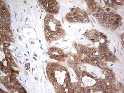 Immunohistochemistry: PIK3CA Antibody (6D9) [NBP2-46403] - Analysis of Carcinoma of Human liver tissue.(Heat-induced epitope retrieval by 1 mM EDTA in 10mM Tris, pH8.5, 120C for 3min)