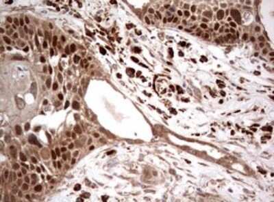 Immunohistochemistry: PIK3CA Antibody (6D9) [NBP2-46403] - Analysis of Carcinoma of Human lung tissue.(Heat-induced epitope retrieval by 1 mM EDTA in 10mM Tris, pH8.5, 120C for 3min)