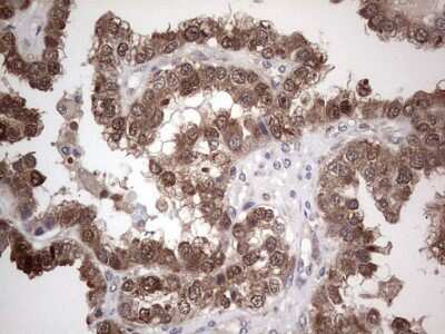 Immunohistochemistry: PIK3CA Antibody (6D9) [NBP2-46403] - Analysis of Adenocarcinoma of Human ovary tissue. (Heat-induced epitope retrieval by 1 mM EDTA in 10mM Tris, pH8.5, 120C for 3min)