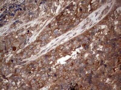 Immunohistochemistry: PIK3CA Antibody (6D9) [NBP2-46403] - Analysis of Adenocarcinoma of Human endometrium tissue. (Heat-induced epitope retrieval by 1 mM EDTA in 10mM Tris, pH8.5, 120C for 3min)