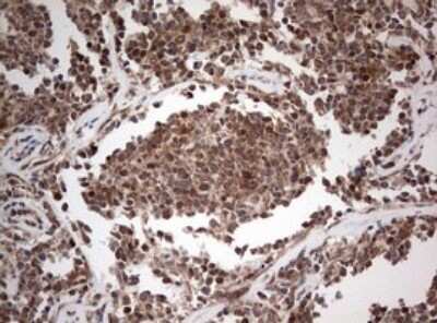 Immunohistochemistry: PIK3CA Antibody (6D9) [NBP2-46403] - Analysis of Human lymphoma tissue. (Heat-induced epitope retrieval by 1 mM EDTA in 10mM Tris, pH8.5, 120C for 3min)