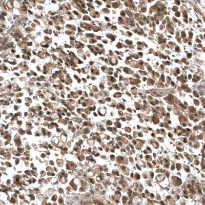 Immunohistochemistry-Paraffin: PIK3CA Antibody (CL8347) [NBP2-88915] - Staining of human stomach cancer shows moderate cytoplasmic positivity in tumor cells.