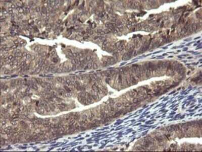 Immunohistochemistry: PIK3R5 Antibody (OTI4G9) [NBP2-46413] - Analysis of Adenocarcinoma of Human endometrium tissue. (Heat-induced epitope retrieval by 10mM citric buffer, pH6.0, 120C for 3min)
