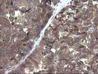Immunohistochemistry: PIK3R5 Antibody (OTI4G9) [NBP2-46413] - Analysis of Adenocarcinoma of Human ovary tissue. (Heat-induced epitope retrieval by 10mM citric buffer, pH6.0, 120C for 3min)