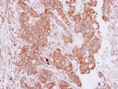 Immunohistochemistry-Paraffin: PIM2 Antibody [NBP1-33731] - Paraffin-embedded Breast ca, using antibody at 1:250 dilution.