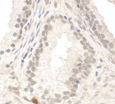 Immunohistochemistry: PIMT Antibody [NB100-2595] - Sample: FFPE section of human prostate carcinoma. Antibody: Affinity purified rabbit anti- PIMT used at a dilution of 1:200 (1ug/ml). Detection: DAB