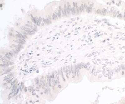 <b>Independent Antibodies Validation. </b>Immunohistochemistry: PIMT Antibody [NBP2-44294] - Sample: FFPE section of human colon carcinoma. Antibody: Affinity purified rabbit anti- PIMT used at a dilution of 1:1,000 (1ug/ml). Detection: DAB. Counterstain: IHC Hematoxylin (blue).