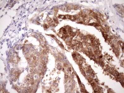 Immunohistochemistry: PIN4 Antibody (7H2) [NBP2-46420] - Analysis of Carcinoma of Human liver tissue. (Heat-induced epitope retrieval by Tris-EDTA, pH8.0)