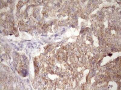 Immunohistochemistry: PIN4 Antibody (7H2) [NBP2-46420] - Analysis of Adenocarcinoma of Human ovary tissue. (Heat-induced epitope retrieval by Tris-EDTA, pH8.0)