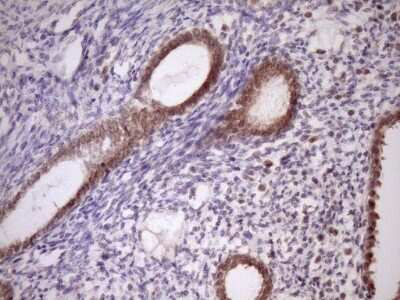 Immunohistochemistry: PIN4 Antibody (7H2) [NBP2-46420] - Analysis of Carcinoma of Human pancreas tissue. (Heat-induced epitope retrieval by Tris-EDTA, pH8.0)