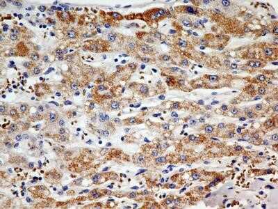 Immunohistochemistry: PINK1 Antibody (8E10.1D6) - Azide and BSA Free [NBP2-80910] - Analysis of FFPE tissue section of human hepatocellular carcinoma using PINK1 antibody (clone 8E10.1D6) at 5 ug/ml concentration. The cancer cells developed an expected punctate to granular cytoplasmic staining with no signal in the tumor stroma. Image fr