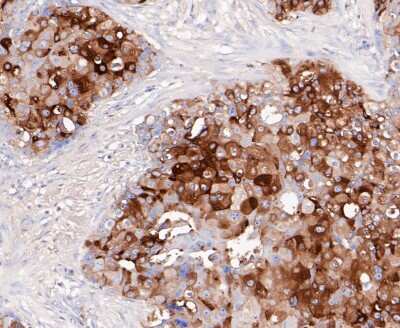 Immunohistochemistry-Paraffin: PIP Antibody (JE48-53) [NBP2-80472] - Analysis in human breast cancer tissue using PIP antibody. The section was pre-treated using heat mediated antigen retrieval with Tris-EDTA buffer (pH 8.0-8.4) for 20 minutes. The tissues were blocked in 5% BSA for 30 minutes at room temperature, washed w